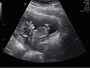 Echographie Octobre 2014